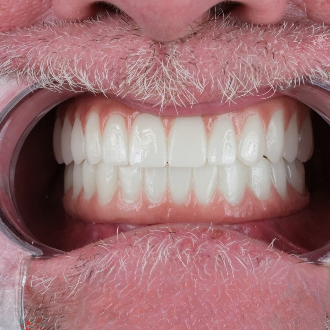 Why Is the Implant Applied, and Can It Be Done With Bone Resorption?