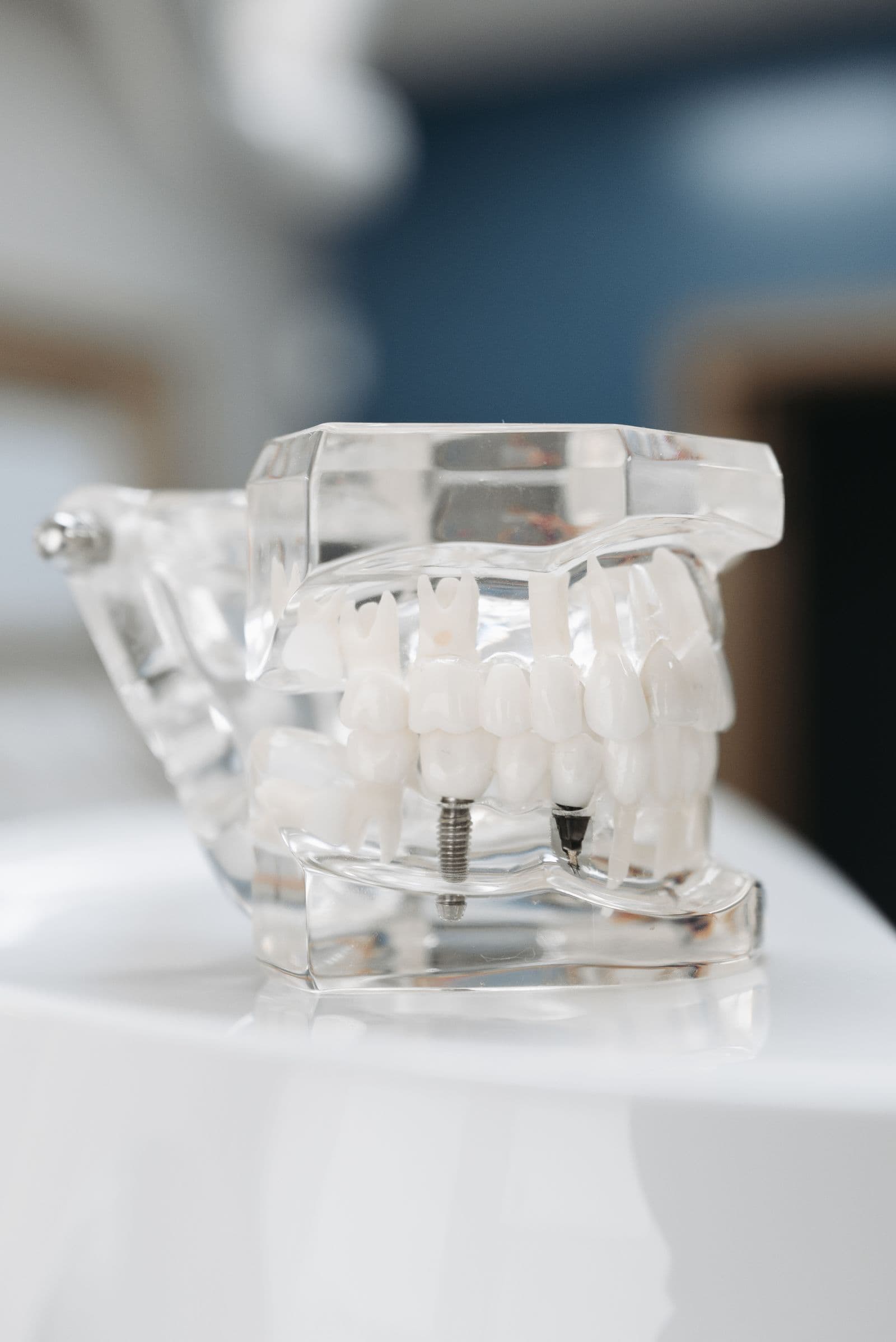 Factors affecting the lifespan of dental implants: