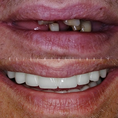 All-on-6-dental-implant
