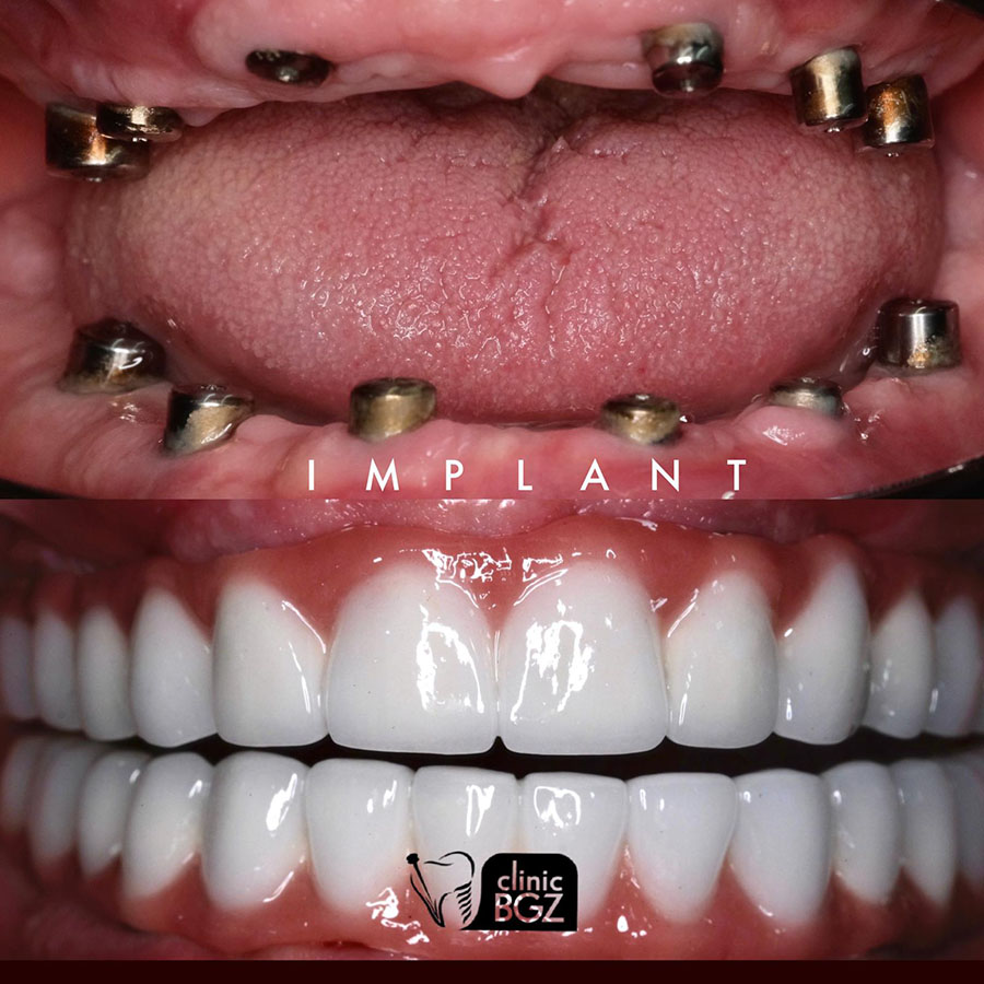 dental implant antalya